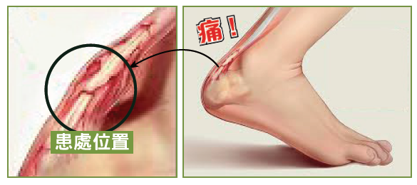 阿基里斯跟腱痛患處位置示意圖